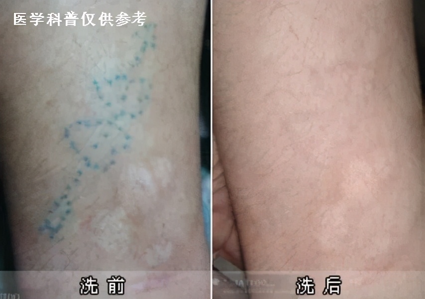 纹身激光去除后可以参军吗,激光去除纹身疤痕可以当兵吗