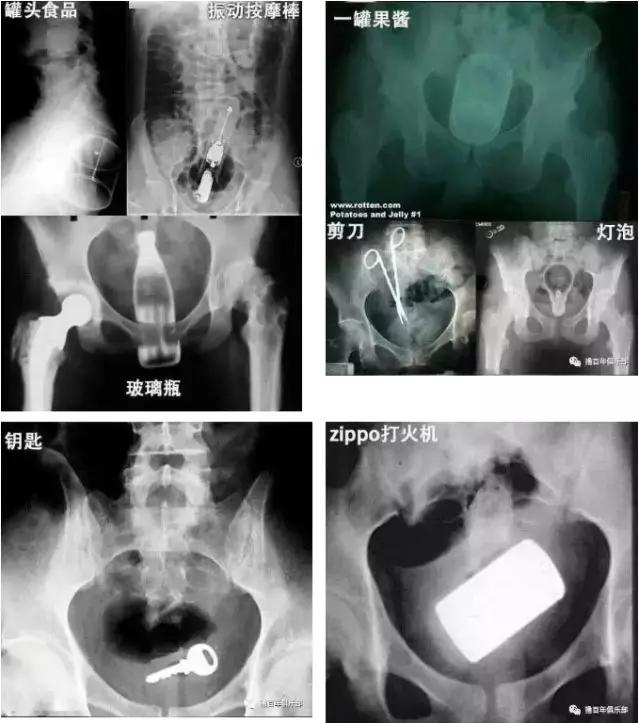 神操作！东莞阿叔将18cm长玻璃瓶塞进肛门...