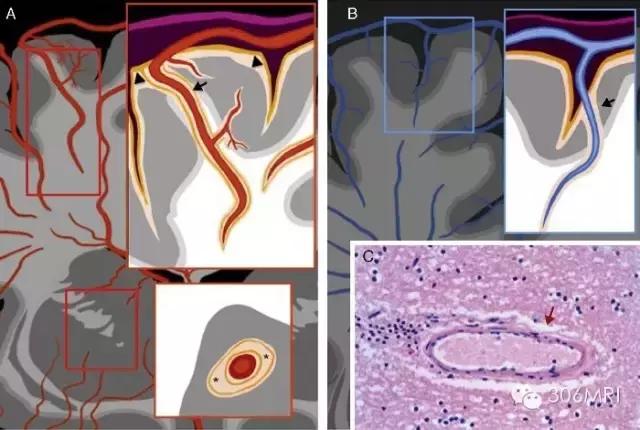 大脑深部白质区见斑点状异常信号,脑白质病变建议mri检查是什么意思