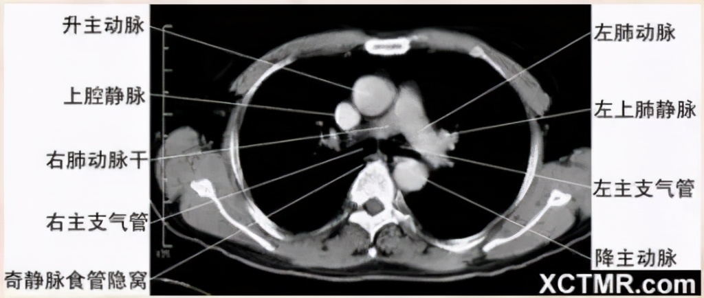 女性盆腔ct断层解剖结构图,女性盆腔脏器ct解剖