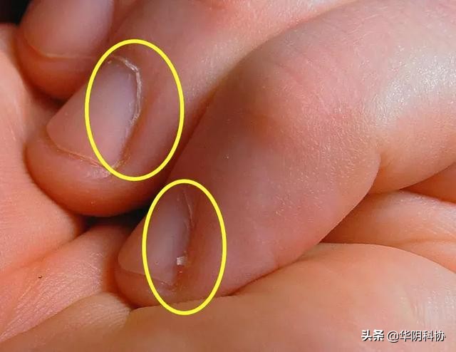 指甲上没月牙有横线长倒刺,关于指甲的科普指甲上的疾病视频