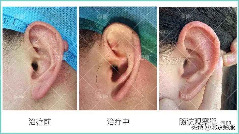 增生性疤痕怎么治疗,激光治疗疤痕一次费用多少钱