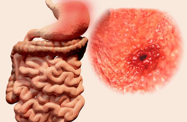 5种征兆暗示胃溃疡沦为胃癌,胃溃疡和早期胃癌的症状区别