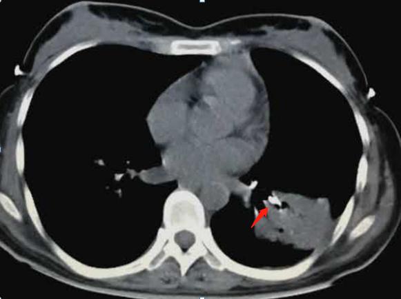 26岁确诊肺癌,26岁得了肺结核