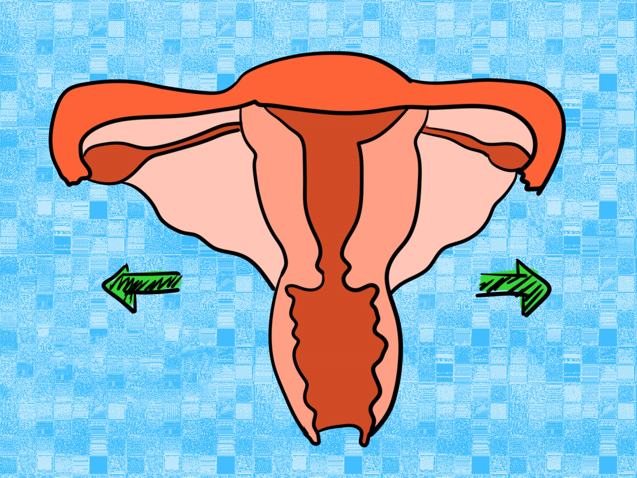 孕妈剖腹产后，保养不当引发宫腔粘连，导致孕育二胎之路艰辛