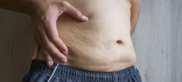 难看又难缠的肥胖纹，要如何预防和去除呢？