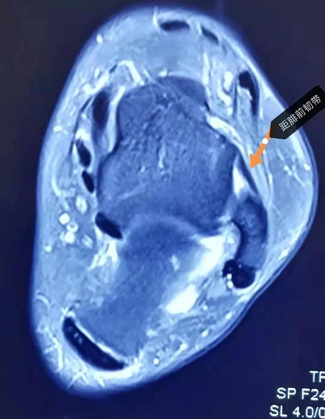 脚踝韧带扭伤的四个恢复阶段,扭脚之后一直不消肿