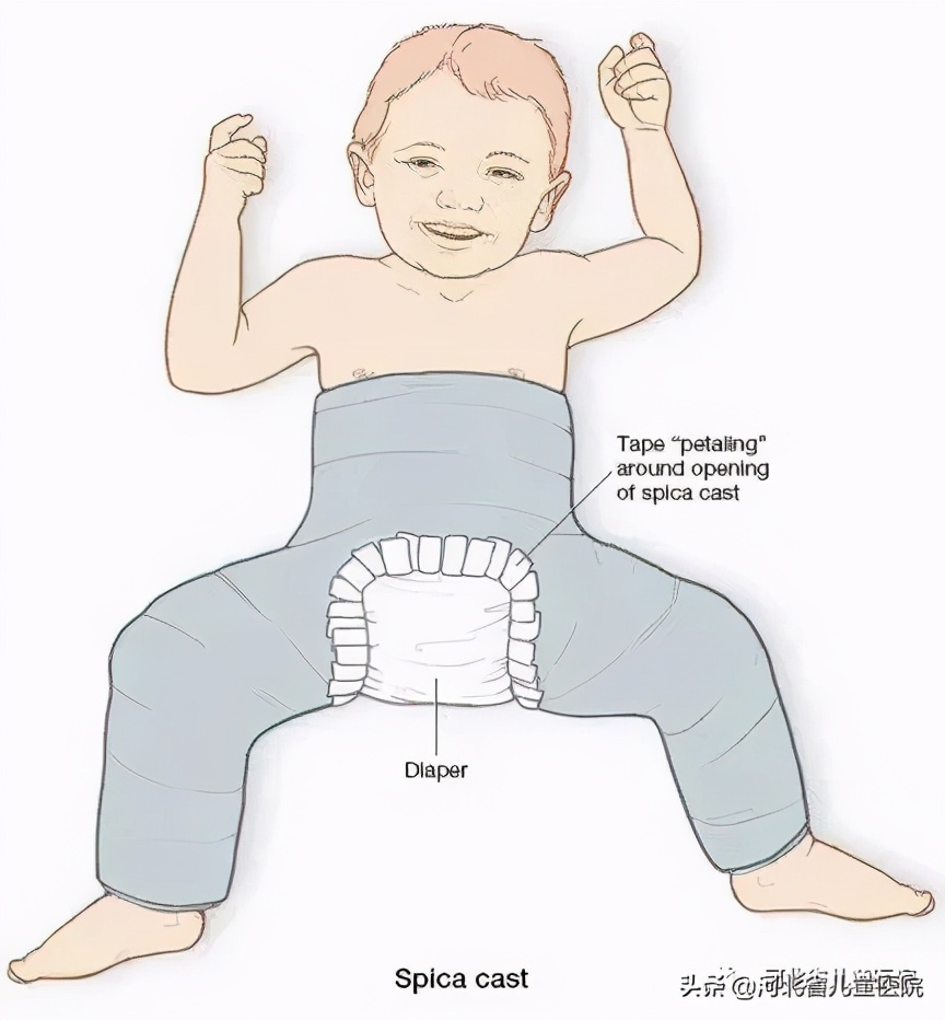 腿纹不对称家长千万别忽视,腿纹深浅不一样算不对称吗