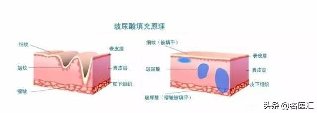 玻尿酸精华水对皮肤的作用与功效,玻尿酸注射之面部提升科普指南篇