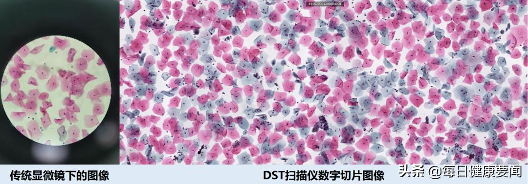 打过宫颈癌针需要查有没有抗体吗,35-45岁打宫颈癌疫苗最适合打几价