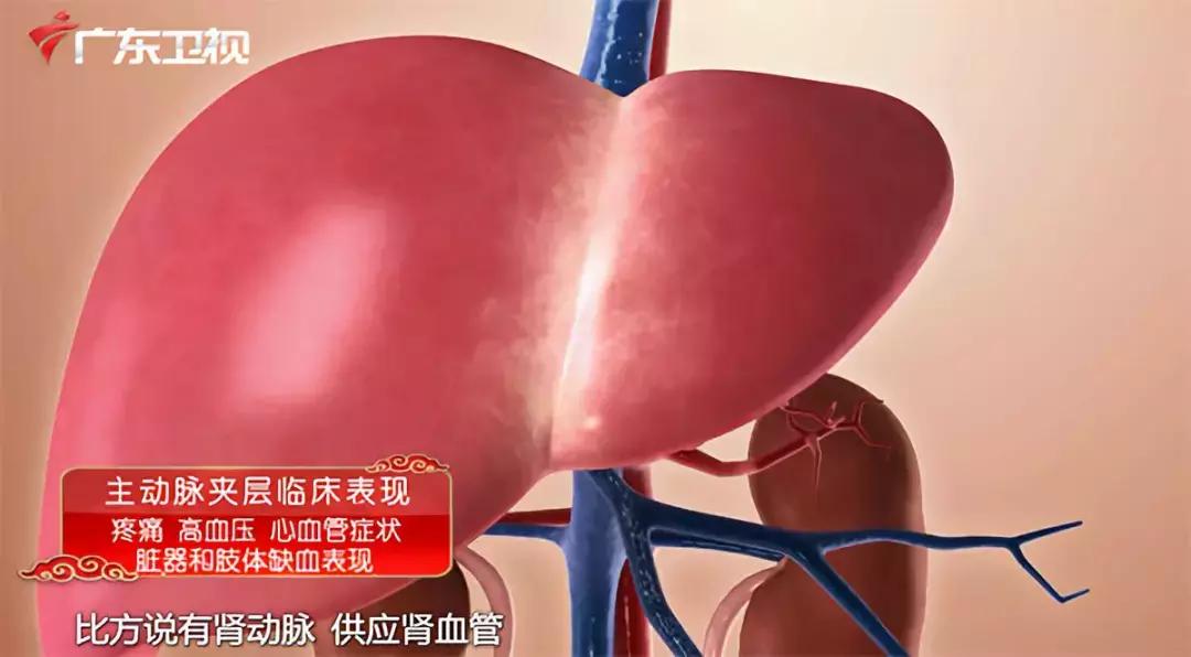 主动脉夹层手术后会猝死吗,主动脉夹层破裂猝死有救吗