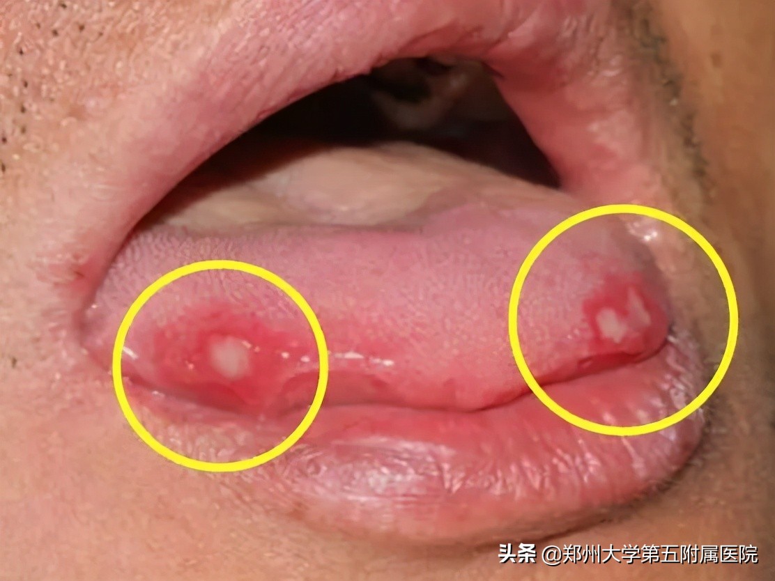 有一种痛叫口腔溃疡图片卡通,口腔溃疡痛用什么药