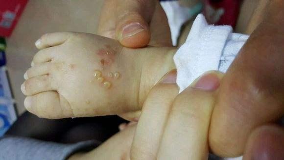 宝宝脚上会出水花吗,宝宝脚上长水泡是湿疹吗