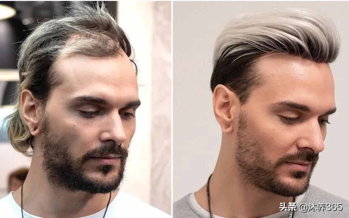 20岁发际线后移的原因,20岁越来越秃的发际线