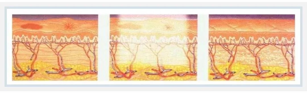 光子和超光子有什么区别,超光子比光子嫩肤贵吗