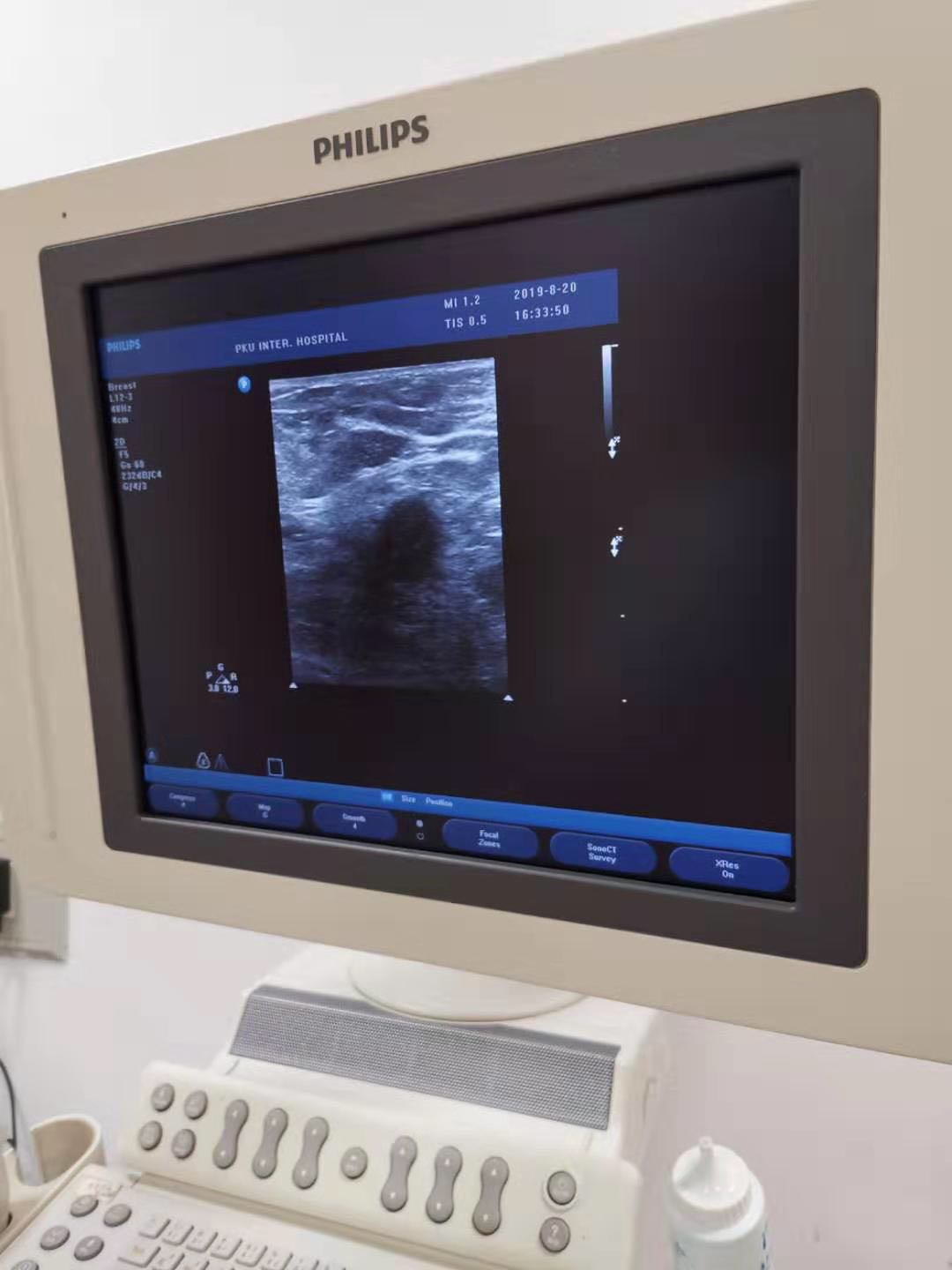 乳腺活检穿刺一般需要多少时间,乳腺bi-rads4b穿刺活检怎么做