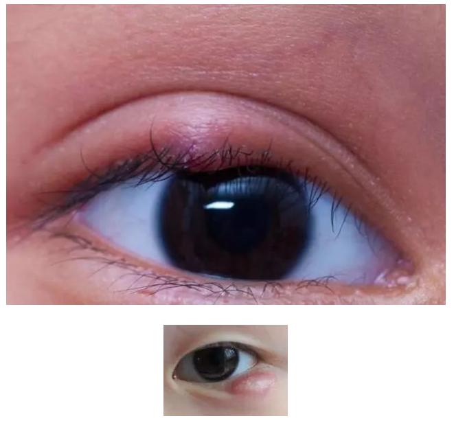 眼睛长疙瘩红肿又疼怎么办,血脂高眼睛上长疙瘩怎么办