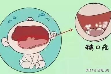 新生儿常见的疾病-婴儿鹅口疮的护理