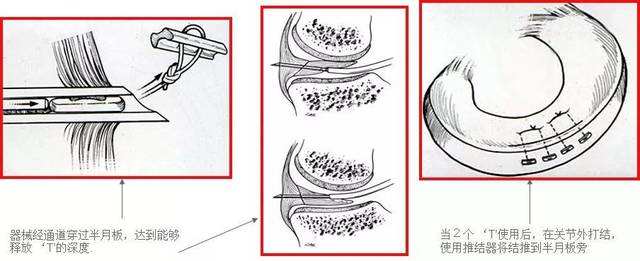 半月板手术修复去哪里做,半月板及韧带损伤做手术