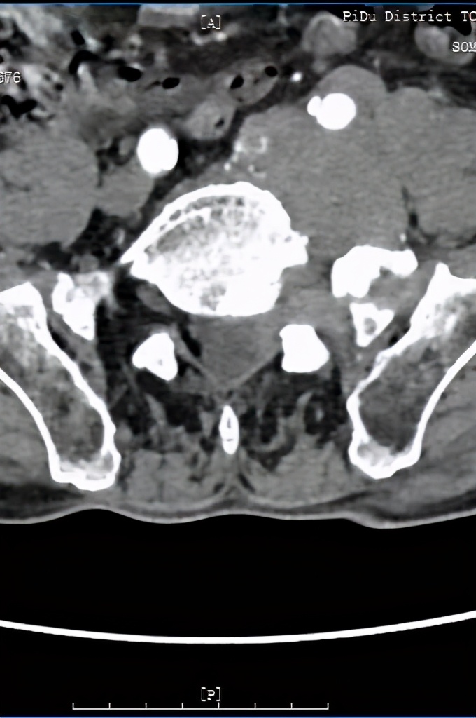 罕见肿瘤中医治疗案例视频,罕见肿瘤中医治疗案例