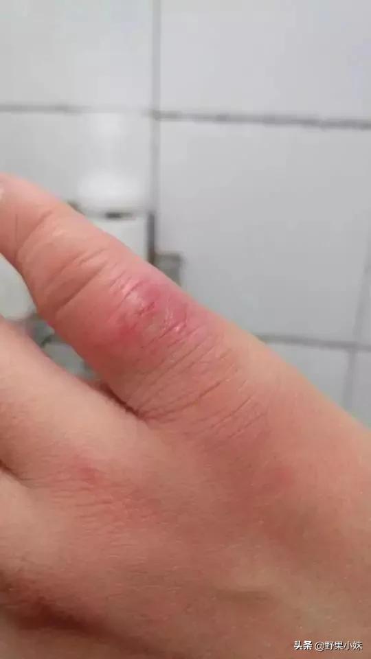 冻疮是怎么形成的原因是什么,冻疮严重溃烂的怎么治