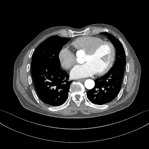 胸部Ct平扫能查出主动脉夹层吗,主动脉夹层cta影像图片解读