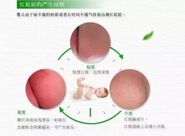 宝宝红屁屁护理心得,宝宝红屁屁痛的直哭怎么办