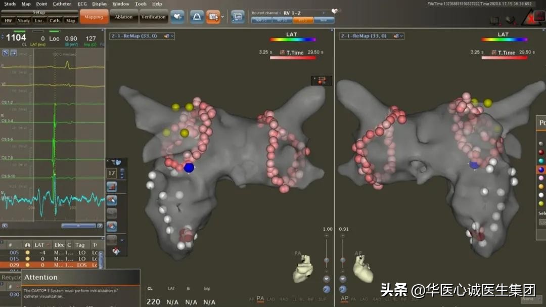 窦性心动过速查房,攀钢集团总医院心内科