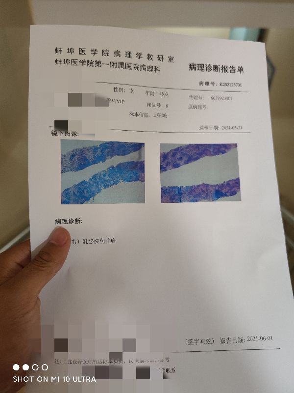 憨娘系列十一：乳腺穿刺显示为恶性