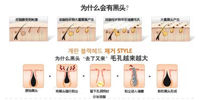 去黑头粉刺最有效的解决方法,如何正确的去黑头粉刺