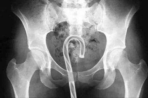 不作死就不会死，看看这些被人类搞进身体里的异物