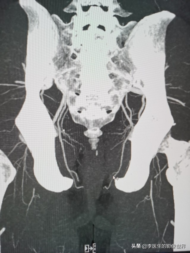 勃起功能障碍,ED之阴部内动脉CT血管成像