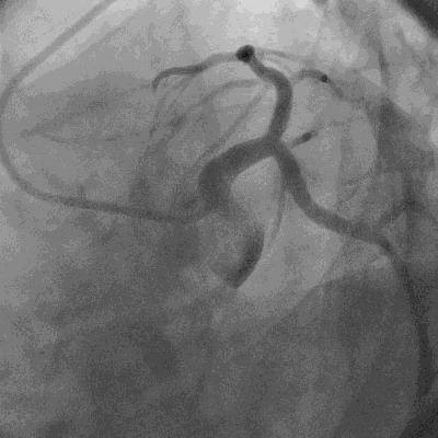 中年男子突发胸痛,中老年劳力性胸痛怎么办