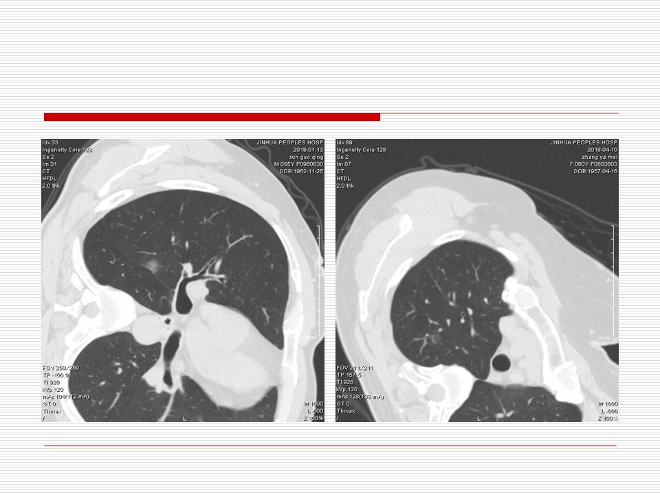 像炎症的肺癌能治好吗,医生说可能是肺癌也可能是炎症