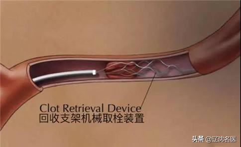 脑血栓血栓一年了还可以取出吗,脑血栓怎么取出血栓