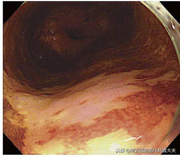 碘染色有助于发现早期食管癌