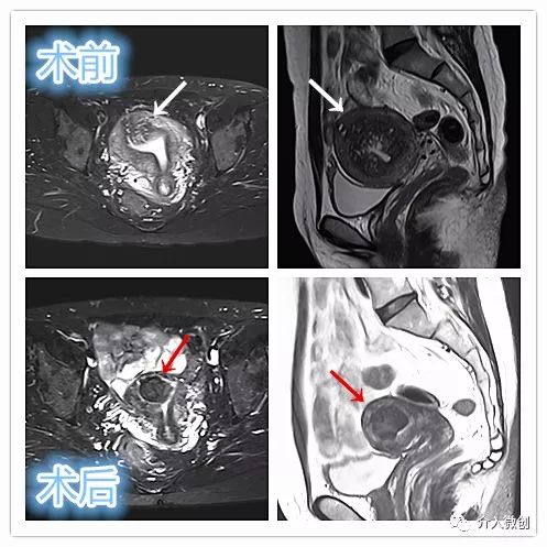 介入治疗腺肌病效果好吗,介入微创治疗子宫腺肌病是什么