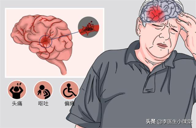 血压高突发脑出血怎么治疗30岁,高血压脑出血突然发作该如何急救