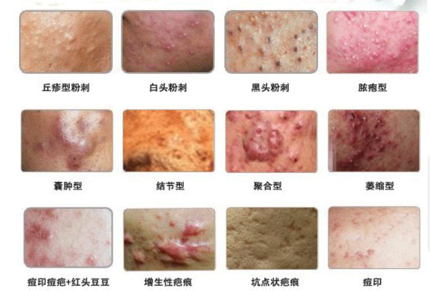 陈年黑头粉刺痘痘清除过程,痘痘粉刺反复长是什么原因