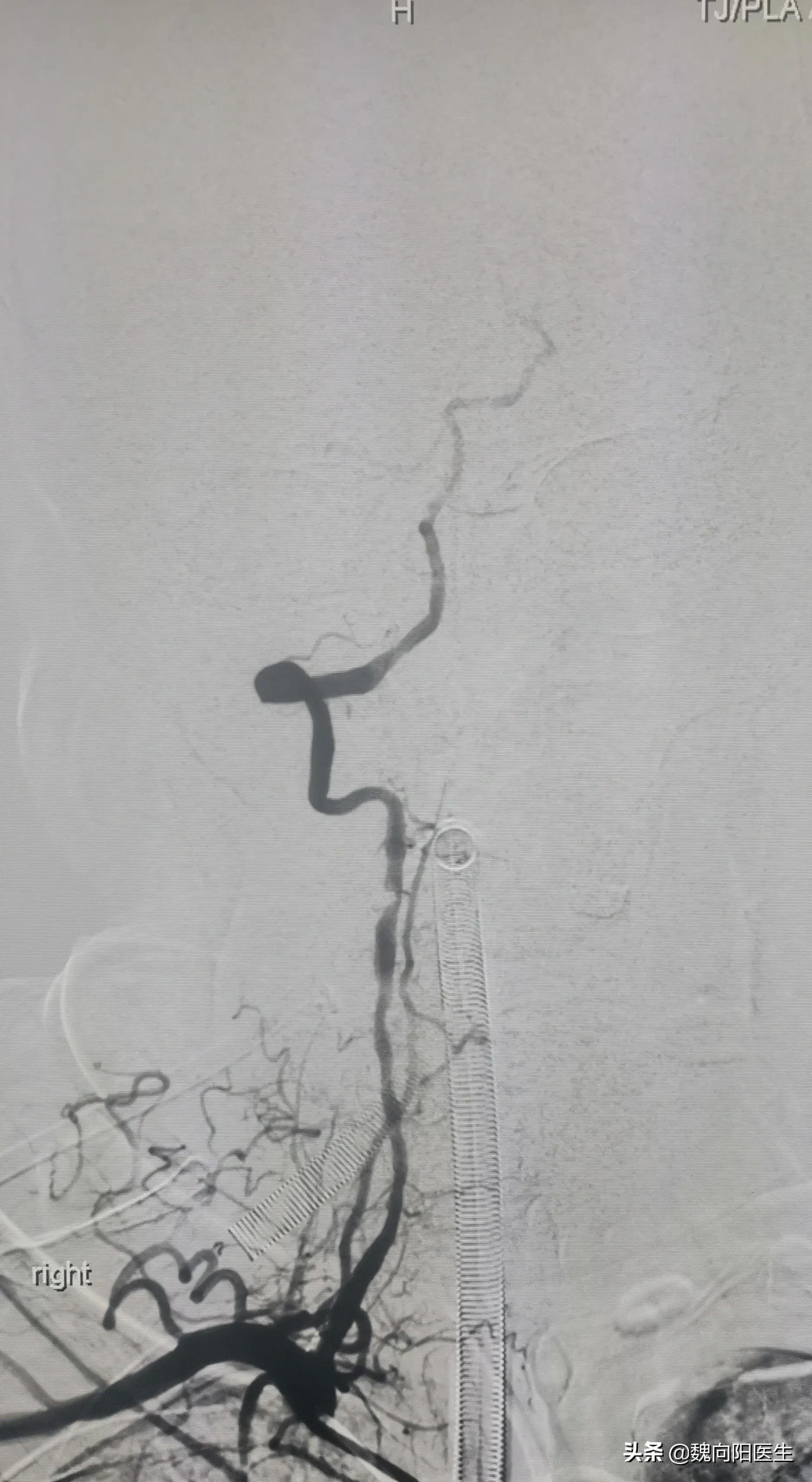 细若头发丝的椎动脉引发严重脑梗塞，开通之后希望早日康复