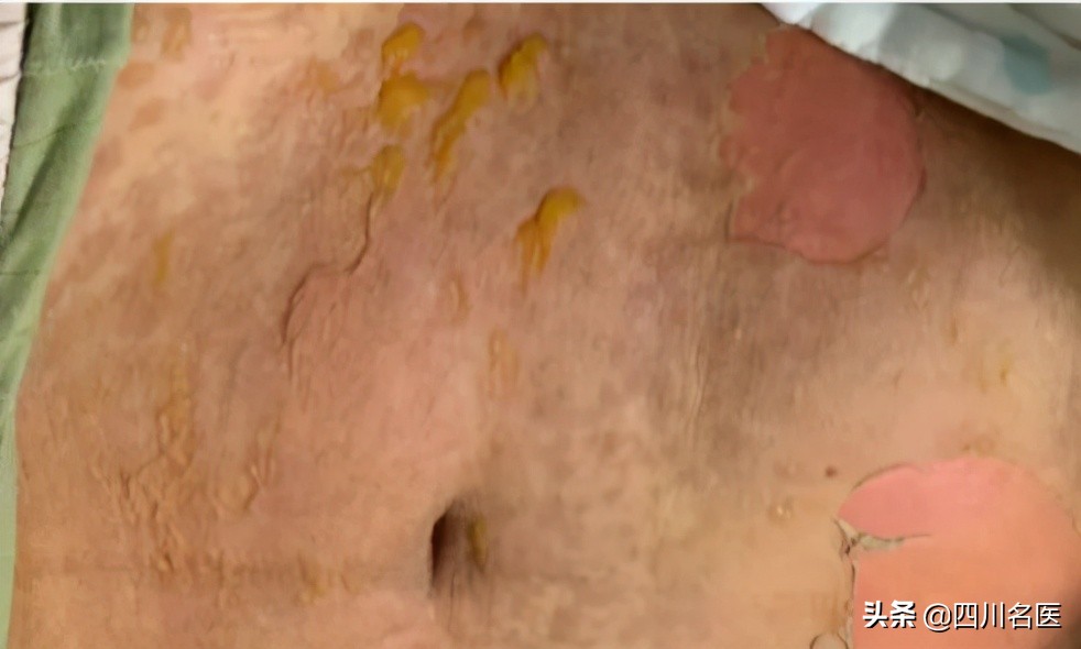 发烧引起皮肤溃烂,发烧过后最里面大面积溃烂