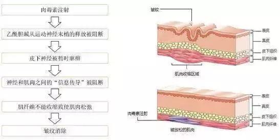 肉毒素瘦脸的保持时间,肉毒素也能瘦脸吗