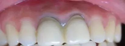 氧化锆全瓷牙的缺点和优点,牙医建议烤瓷不建议全瓷