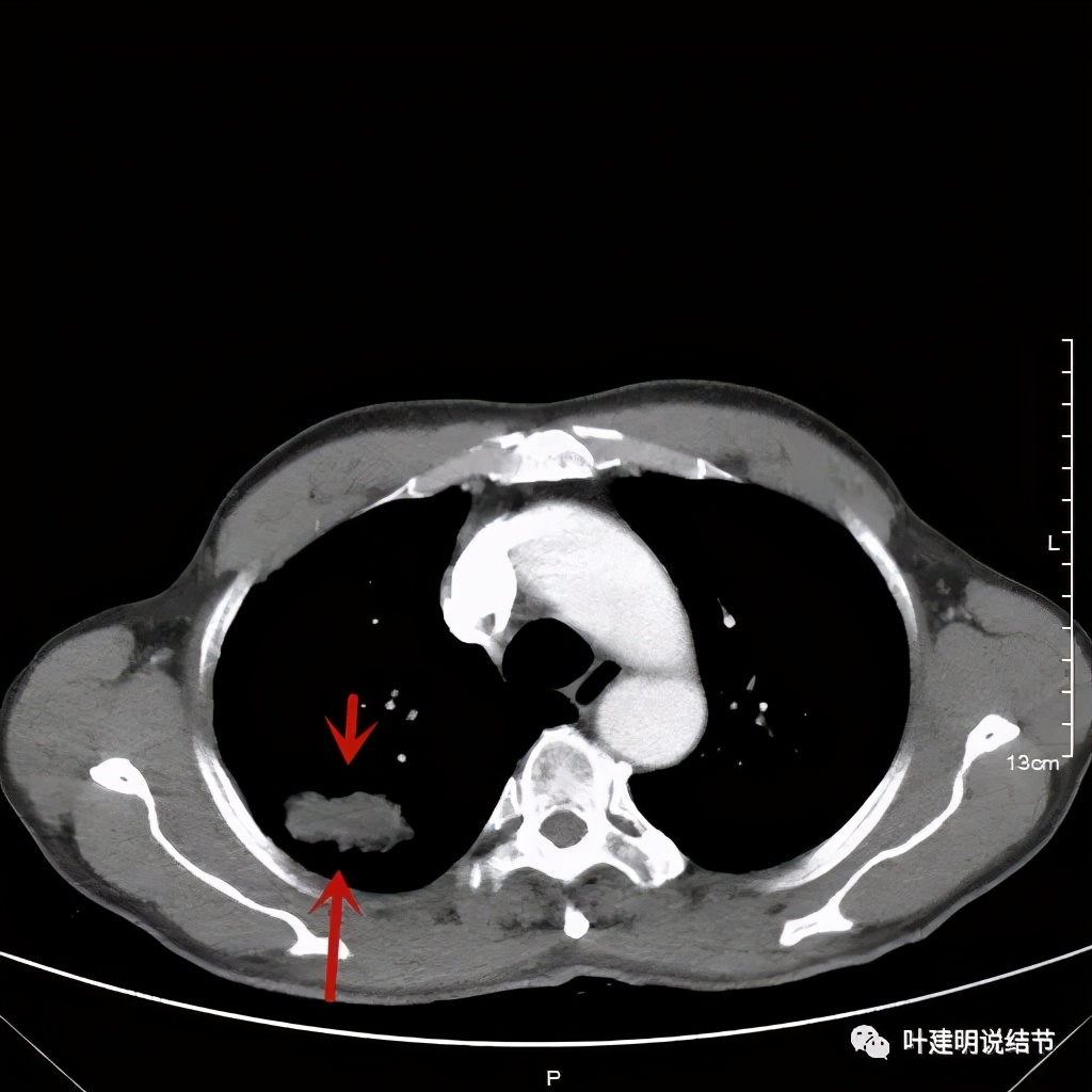 肺占位病理活检无病变,肺部占位穿刺病理说不确定性质