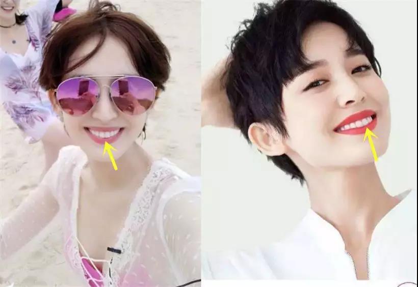 明星做烤瓷牙会做根管治疗吗,烤瓷牙的明星