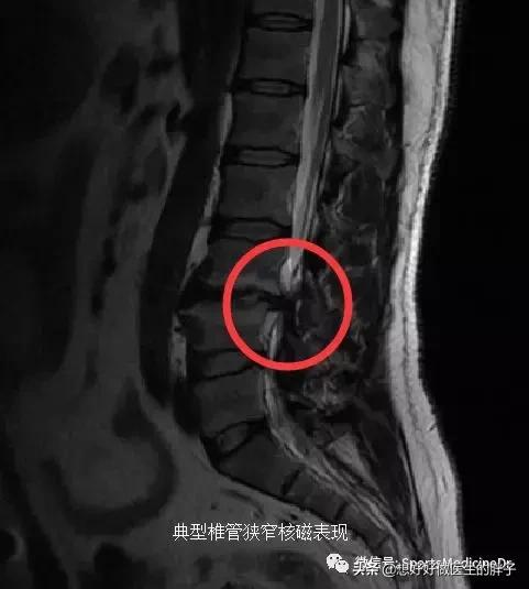 做仰卧起坐真的会腰椎间盘突出吗,仰卧起坐会导致腰椎间盘突出吗