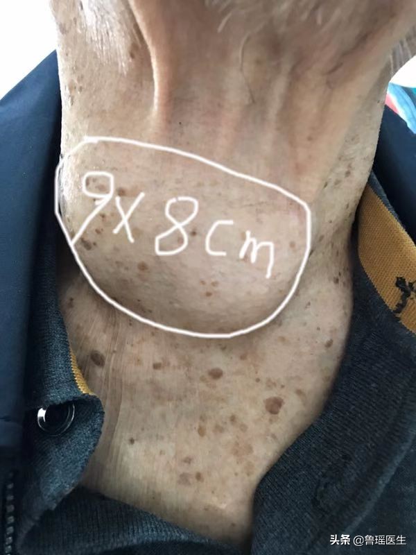 8旬老人甲状腺癌挤压气管向左侧移位术前评估中