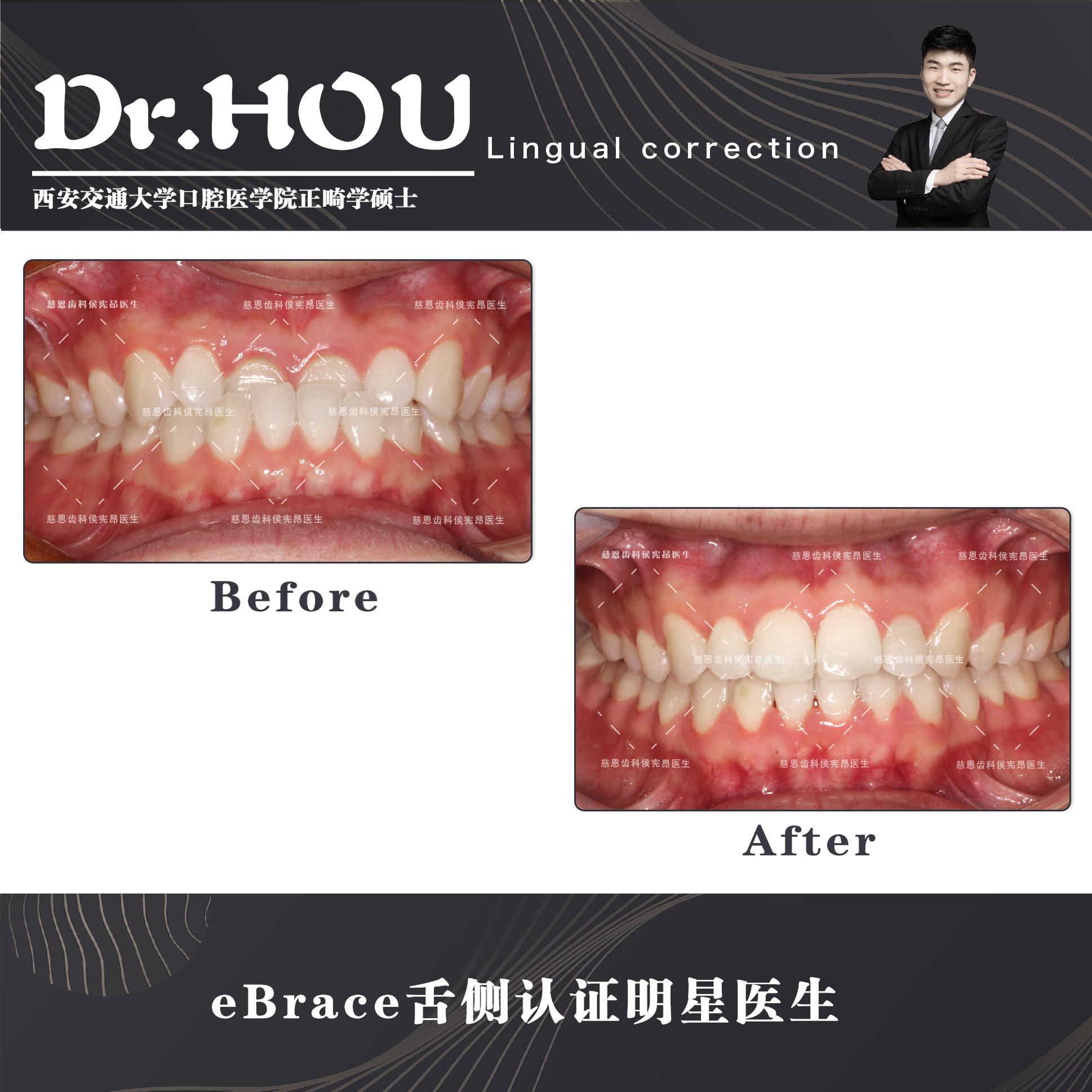 地包天的牙齿图片,牙齿地包天怎么补救