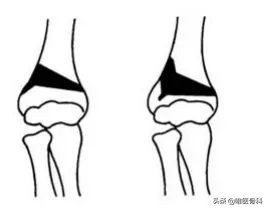 胳膊肘错位肘内翻,先天肘内翻有办法改善吗
