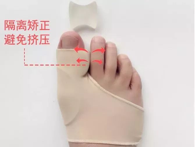 脚趾超级痛,轻度脚趾外翻如何矫正